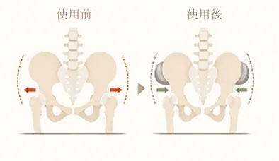 骨盤が開いている人の骨盤の図